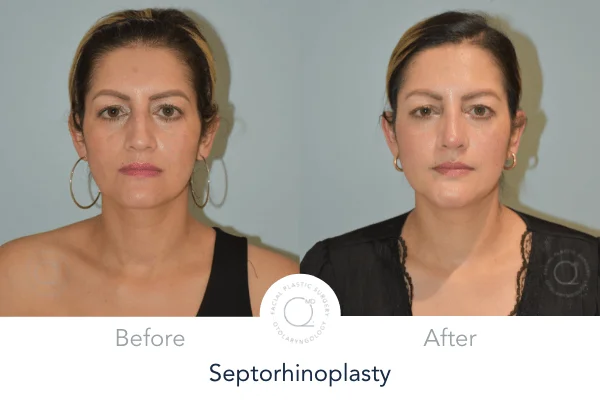 Rinoplastia Madrid caso 1 fotografía 2