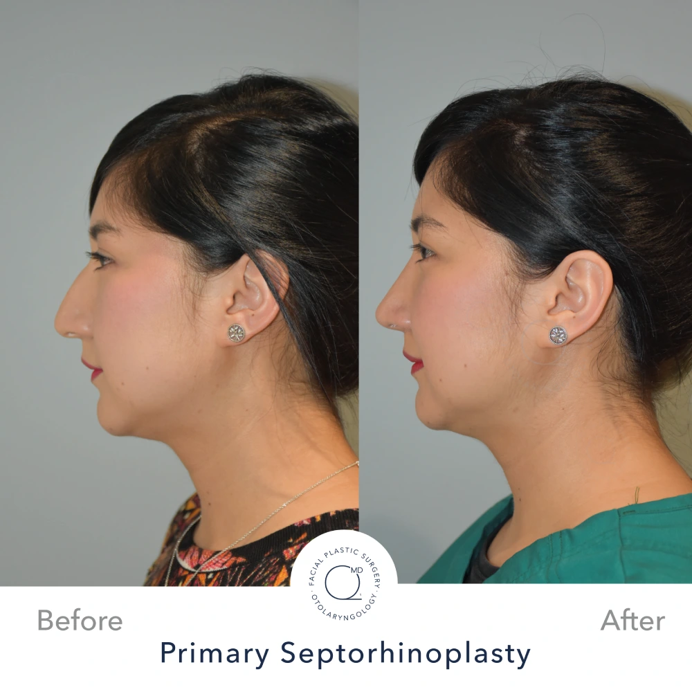 Rinoplastia Madrid caso 10 fotografía 1