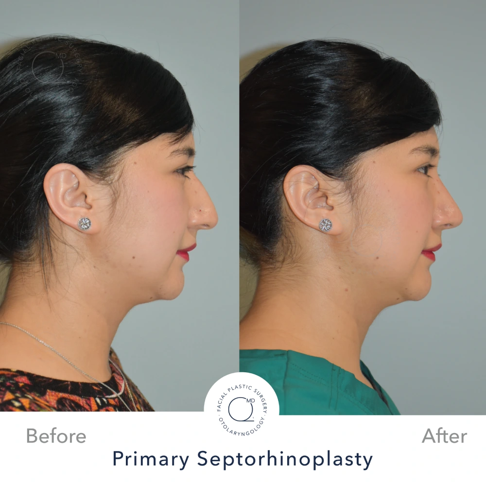 Rinoplastia Madrid caso 10 fotografía 2