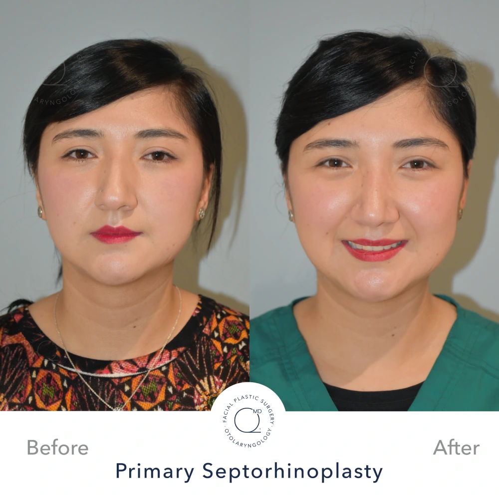 Rinoplastia Madrid caso 10 fotografía 3