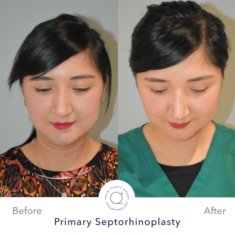 Rinoplastia Madrid caso 10 fotografía 4