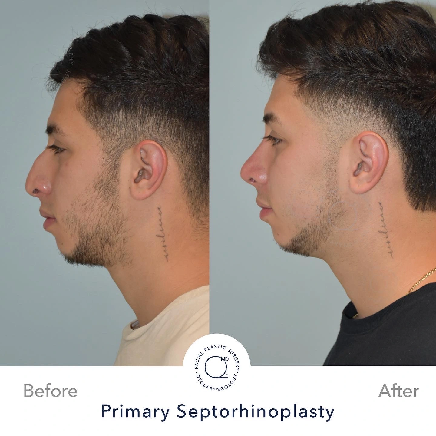 Rinoplastia Madrid caso 11 fotografía 1