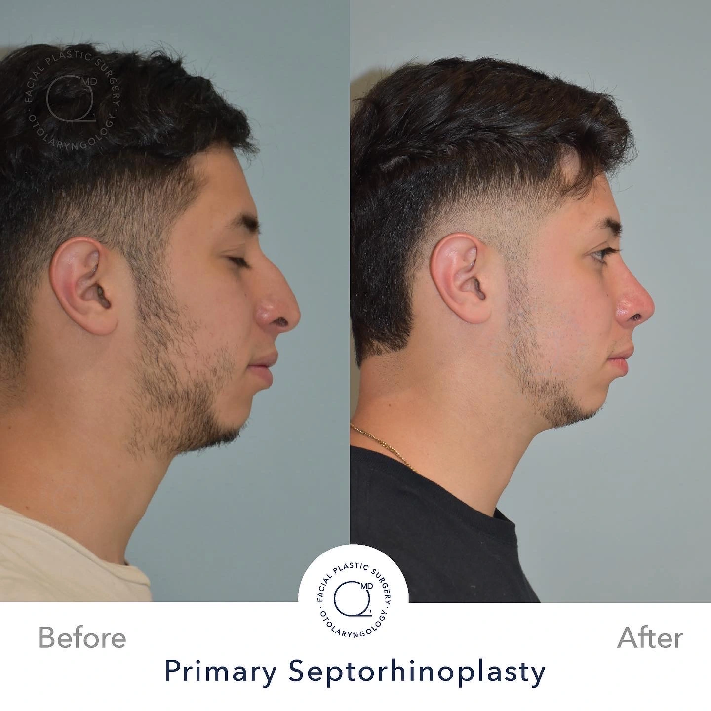 Rinoplastia Madrid caso 11 fotografía 2