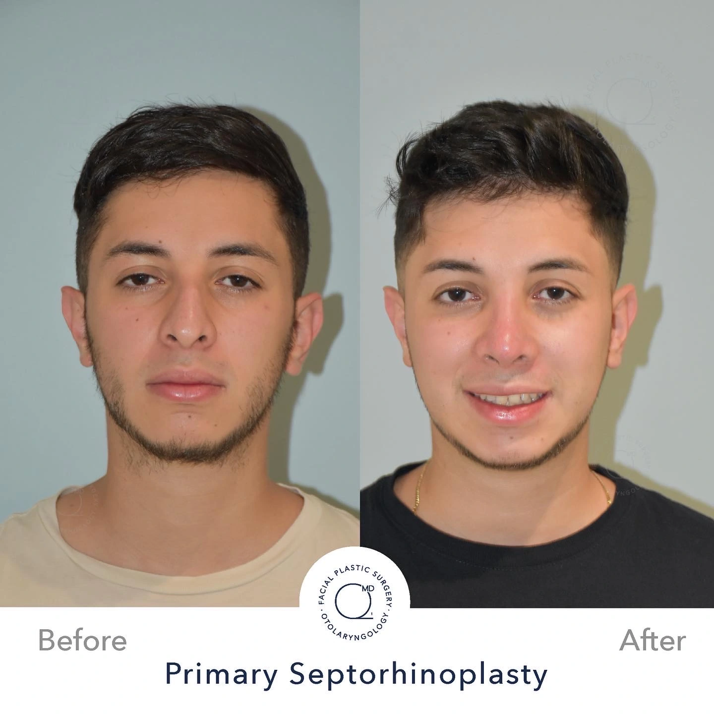 Rinoplastia Madrid caso 11 fotografía 3