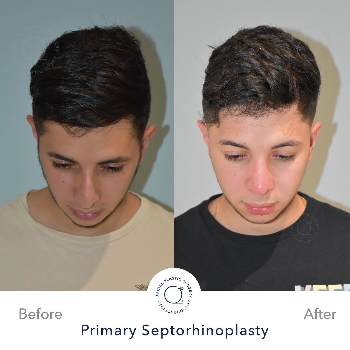 Rinoplastia Madrid caso 11 fotografía 4