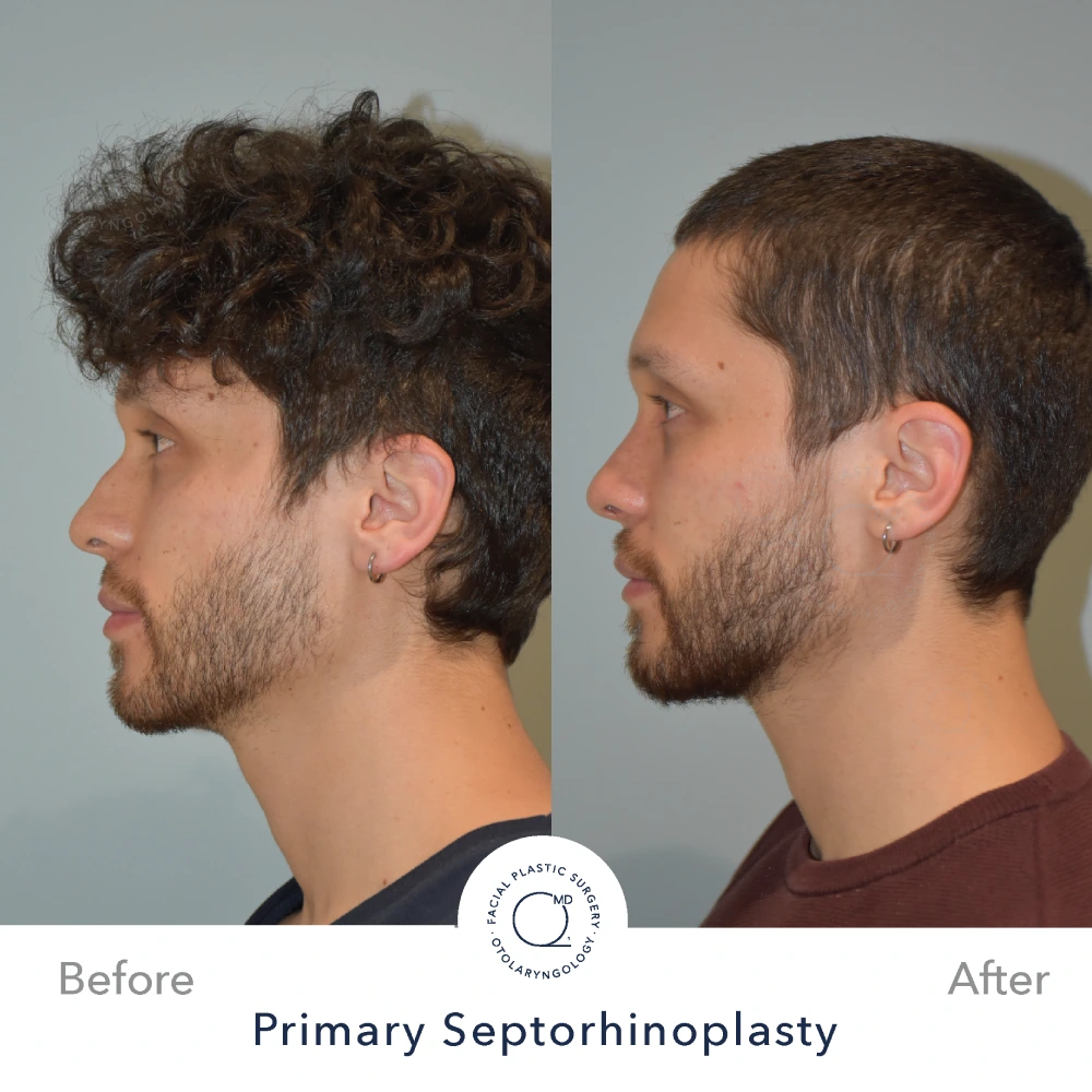 Rinoplastia Madrid caso 12 fotografía 1
