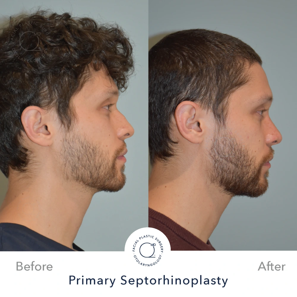 Rinoplastia Madrid caso 12 fotografía 2