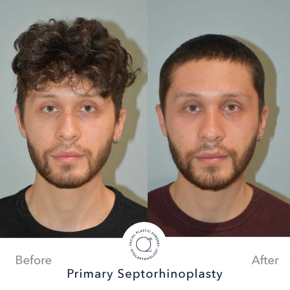 Rinoplastia Madrid caso 12 fotografía 3
