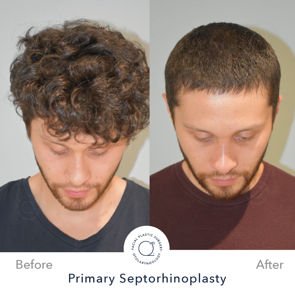 Rinoplastia Madrid caso 12 fotografía 4