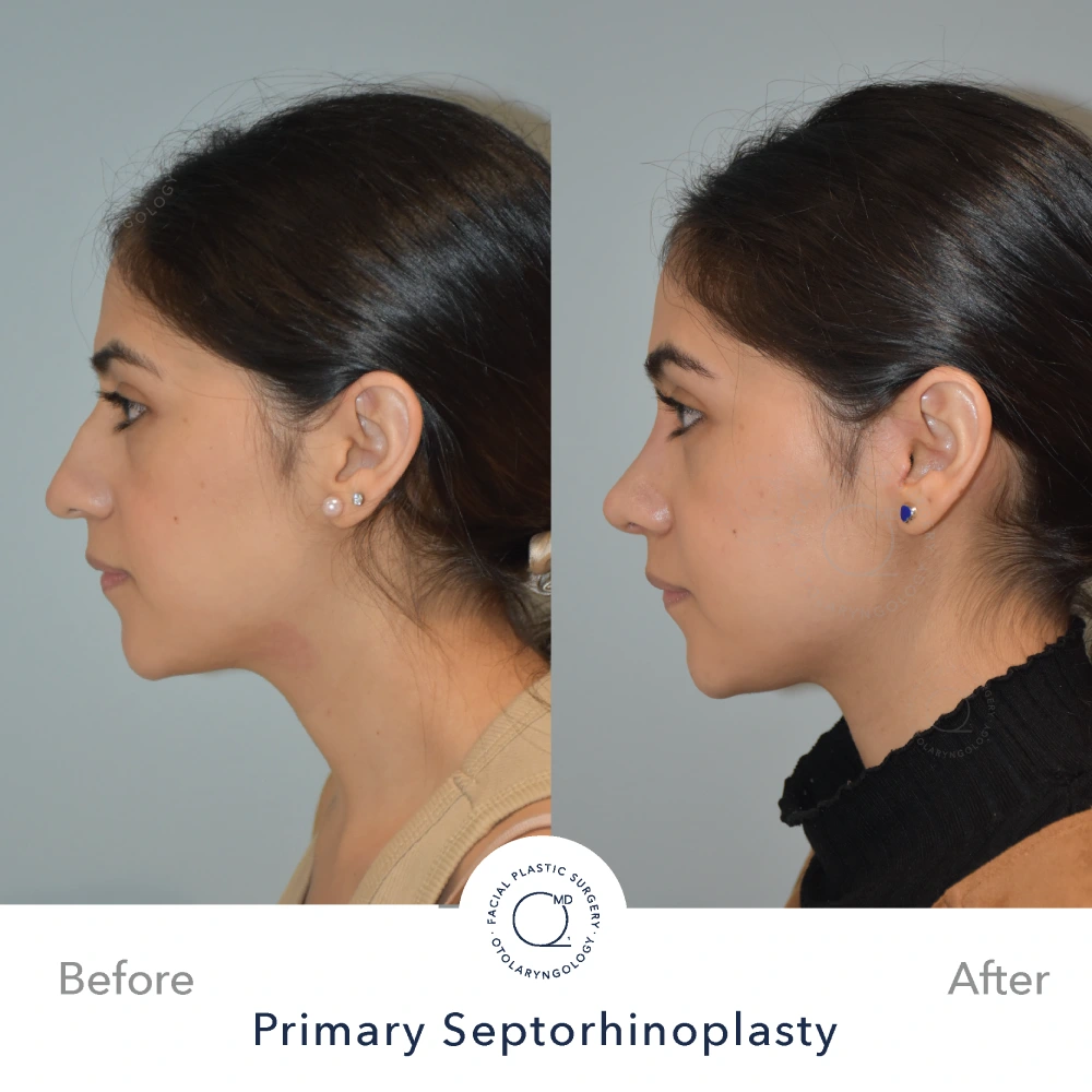 Rinoplastia Madrid caso 14 fotografía 1