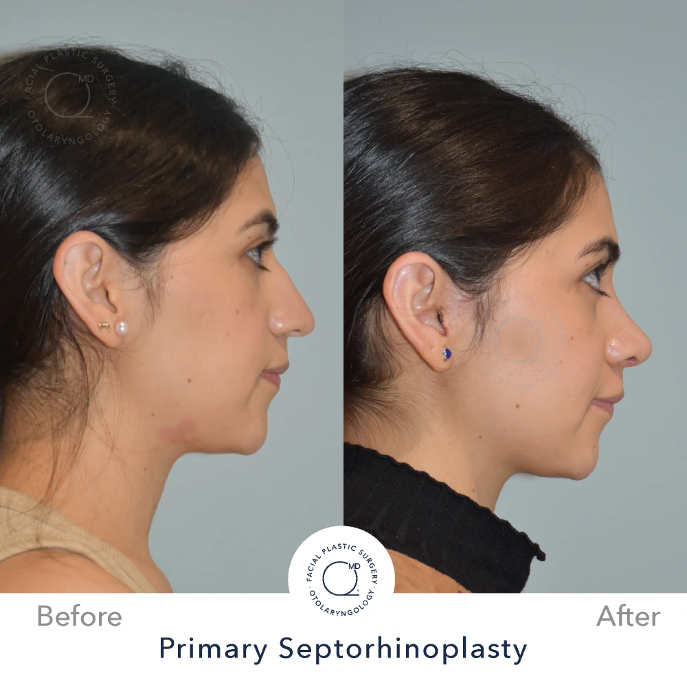 Rinoplastia Madrid caso 14 fotografía 2