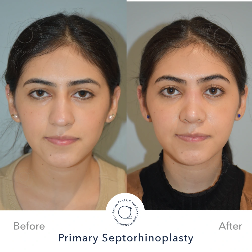 Rinoplastia Madrid caso 14 fotografía 3