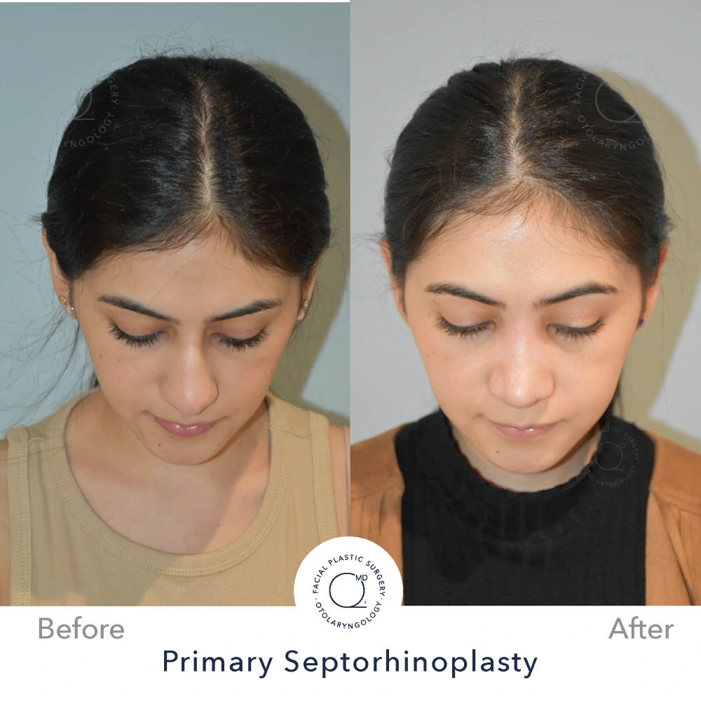 Rinoplastia Madrid caso 14 fotografía 4