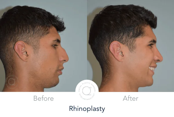 Rinoplastia Madrid caso 15 fotografía 1