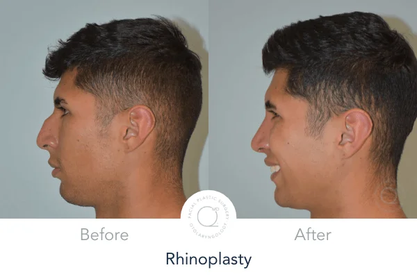 Rinoplastia Madrid caso 15 fotografía 2