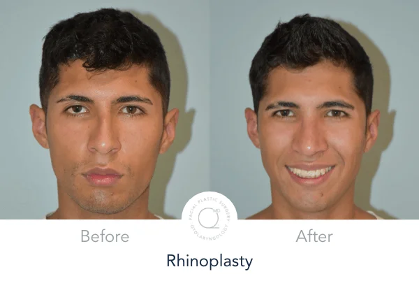 Rinoplastia Madrid caso 15 fotografía 3