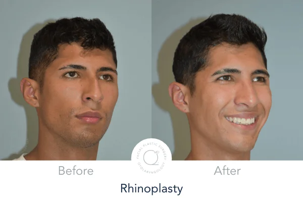 Rinoplastia Madrid caso 15 fotografía 4