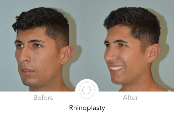 Rinoplastia Madrid caso 15 fotografía 5