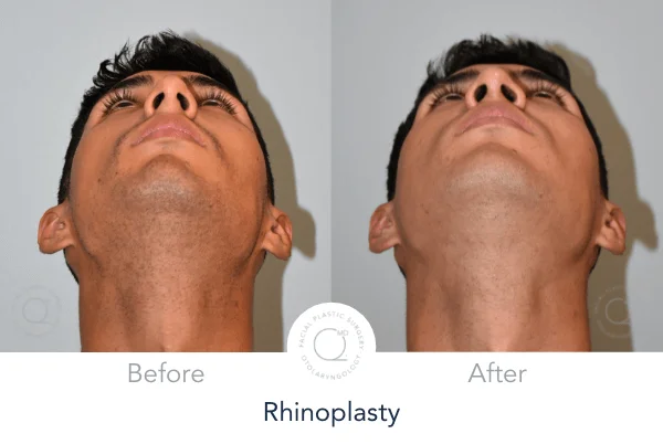 Rinoplastia Madrid caso 15 fotografía 6