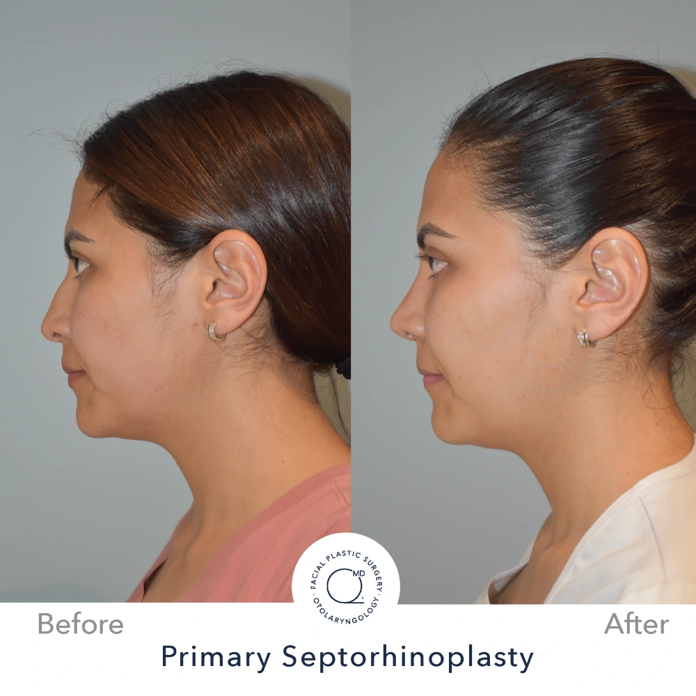Rinoplastia Madrid caso 16 fotografía 1