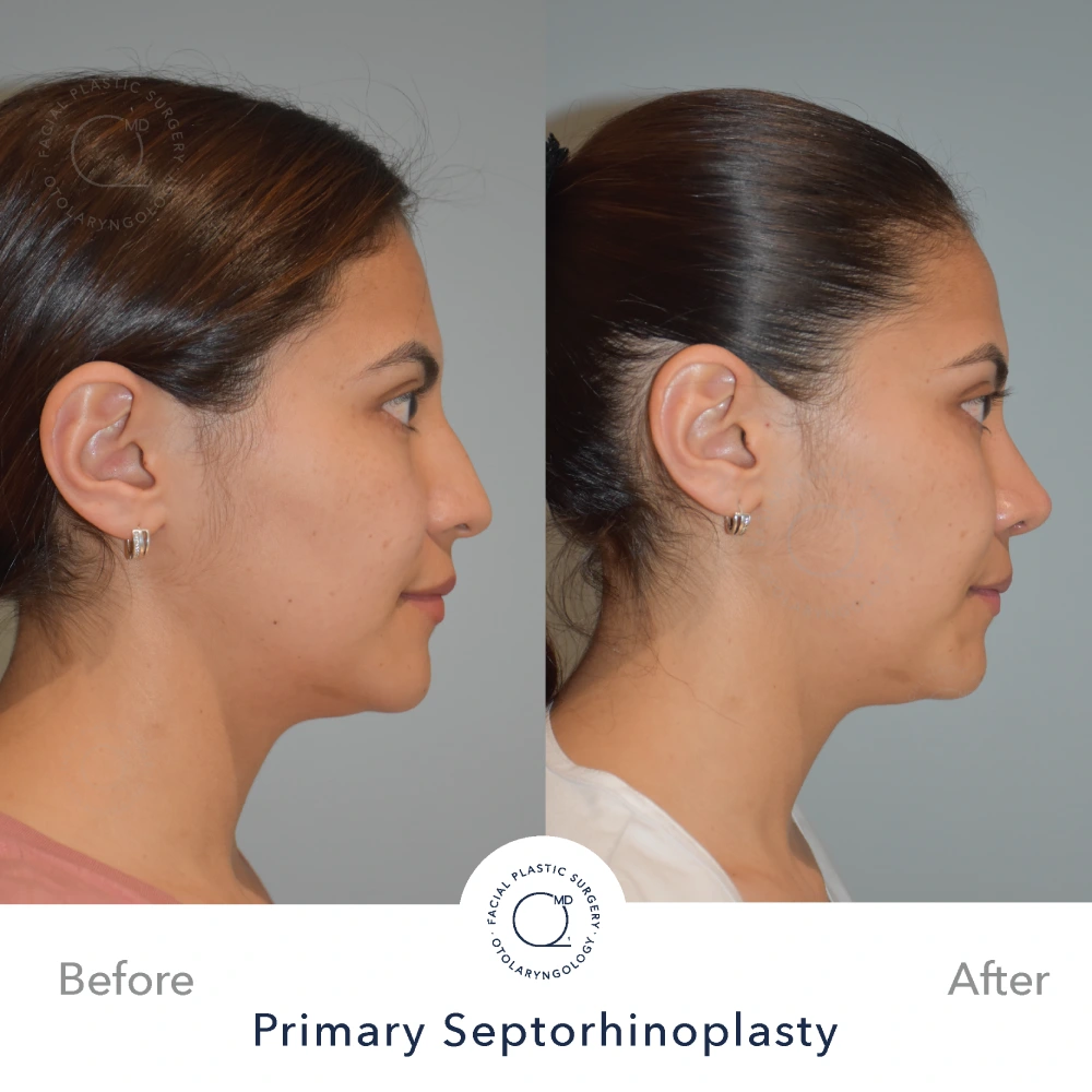 Rinoplastia Madrid caso 16 fotografía 2