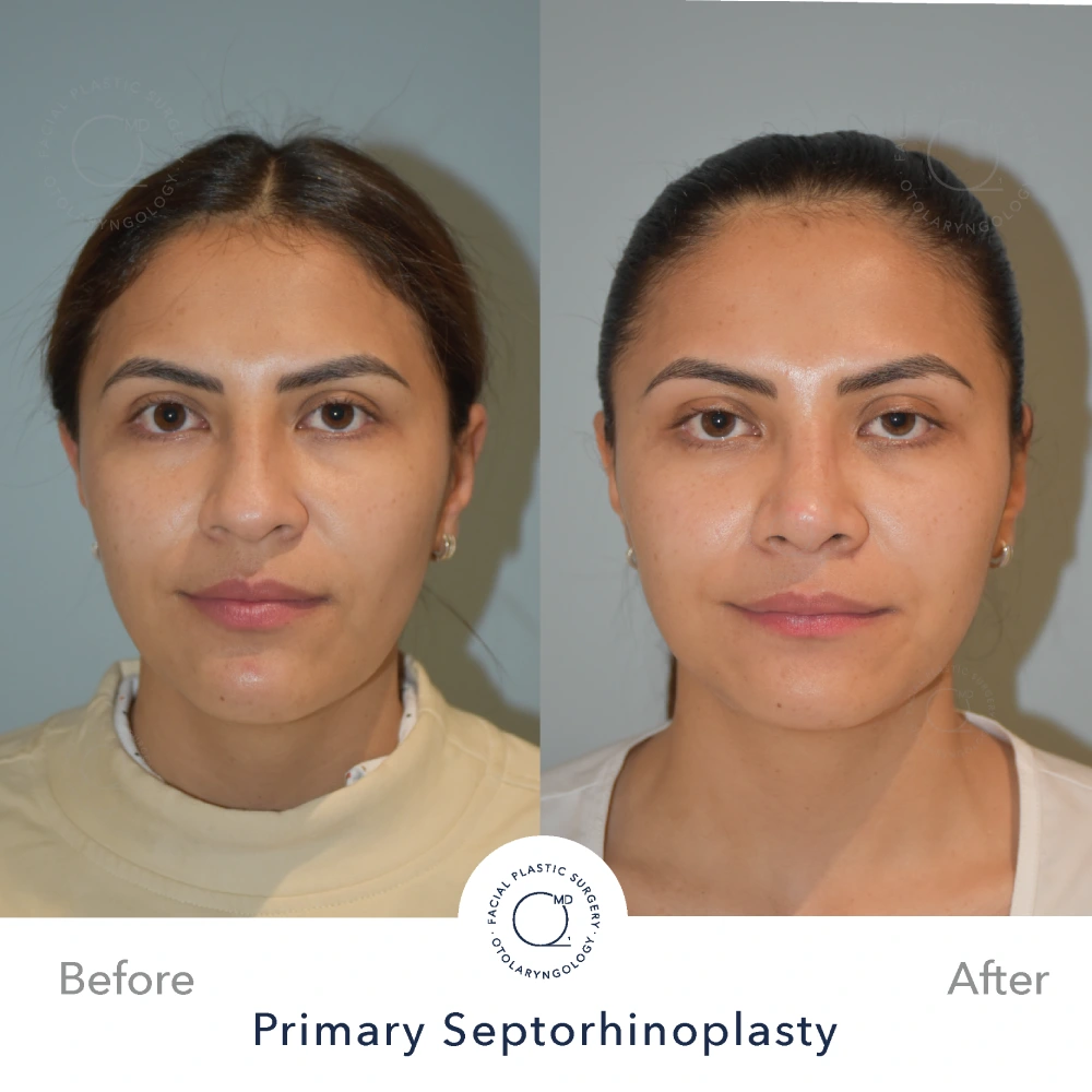 Rinoplastia Madrid caso 16 fotografía 3