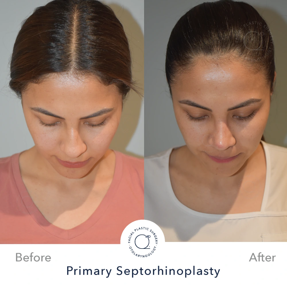 Rinoplastia Madrid caso 16 fotografía 4