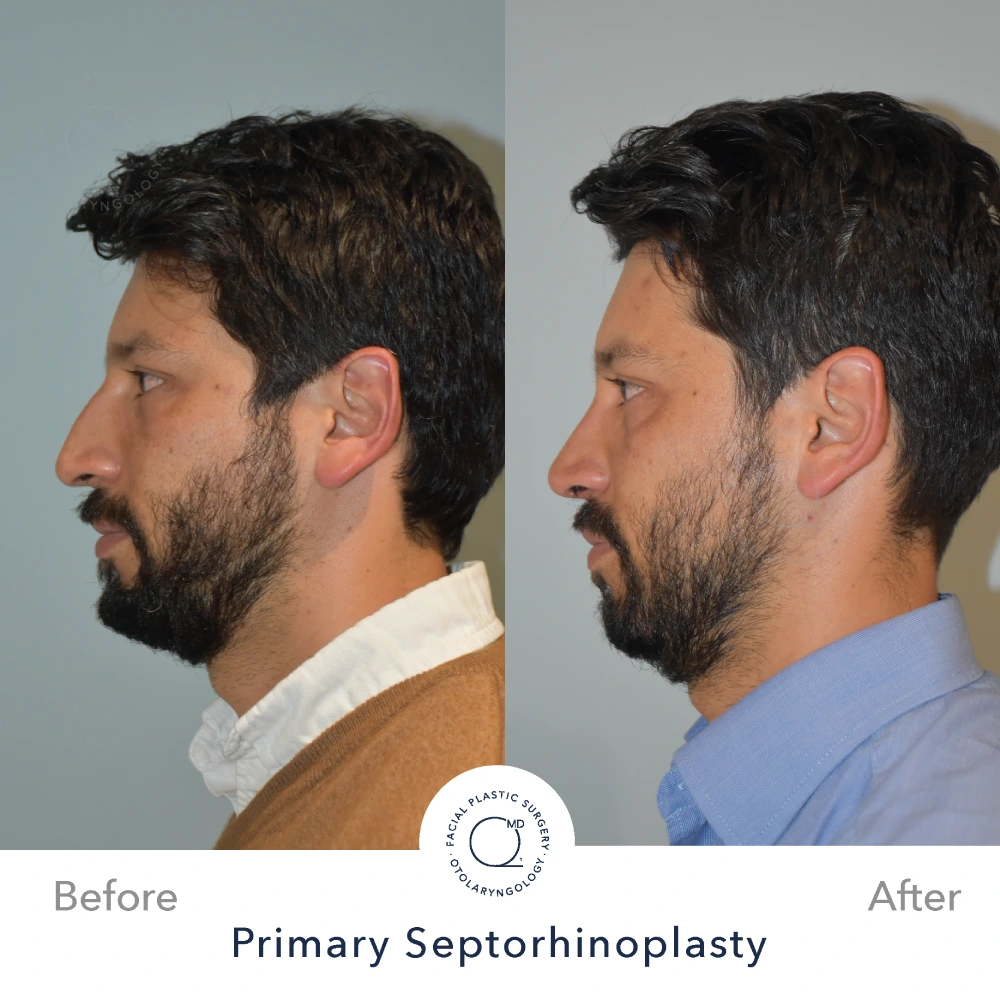 Rinoplastia Madrid caso 17 fotografía 1