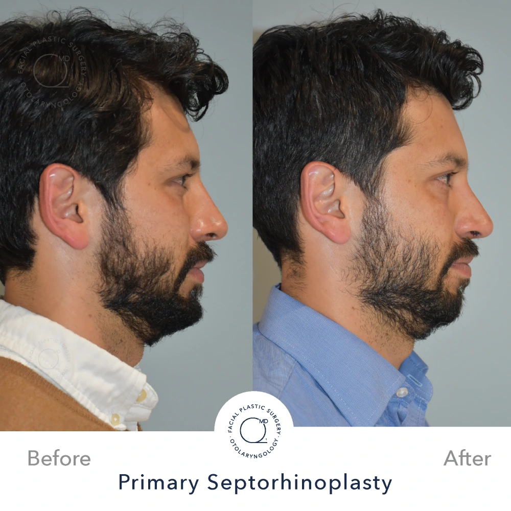 Rinoplastia Madrid caso 17 fotografía 2