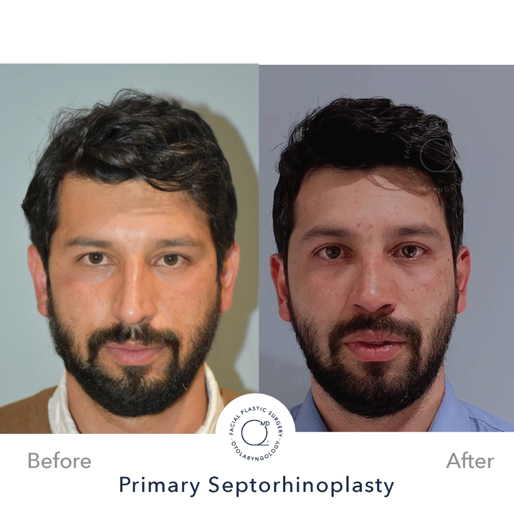 Rinoplastia Madrid caso 17 fotografía 3