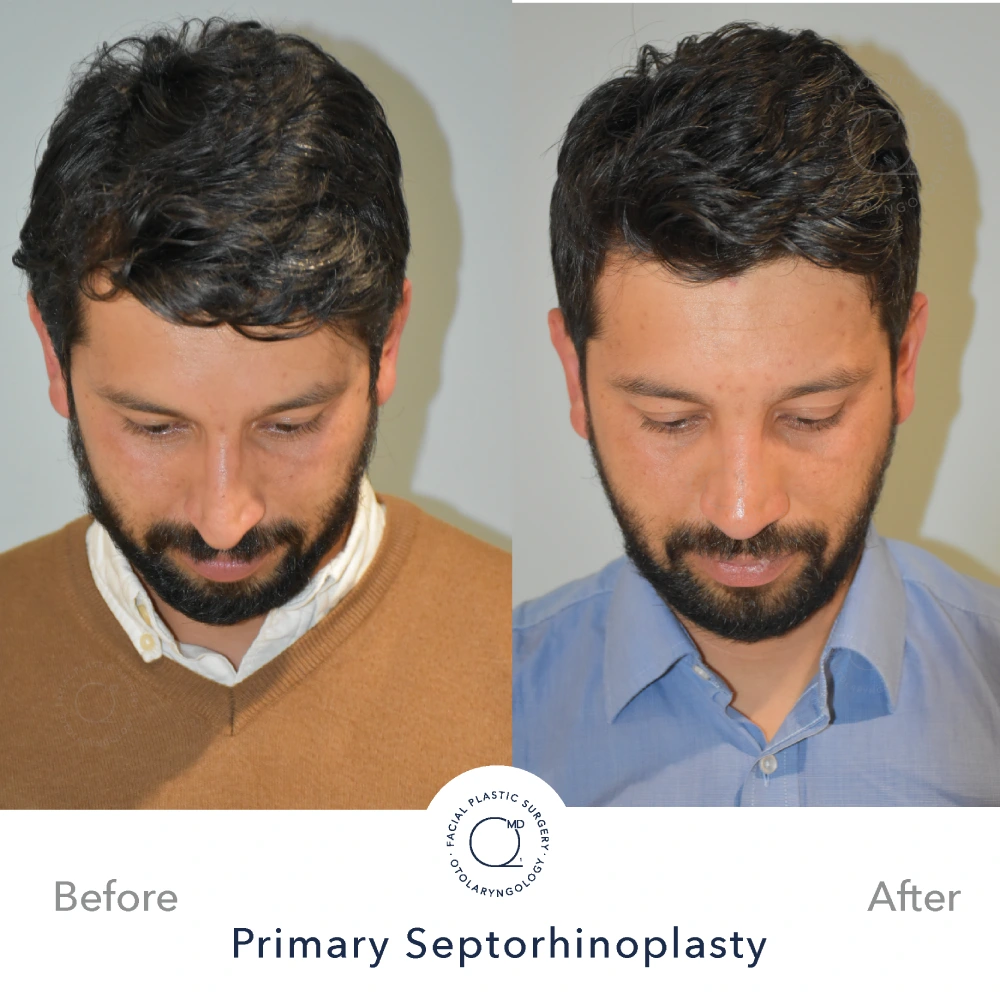 Rinoplastia Madrid caso 17 fotografía 4
