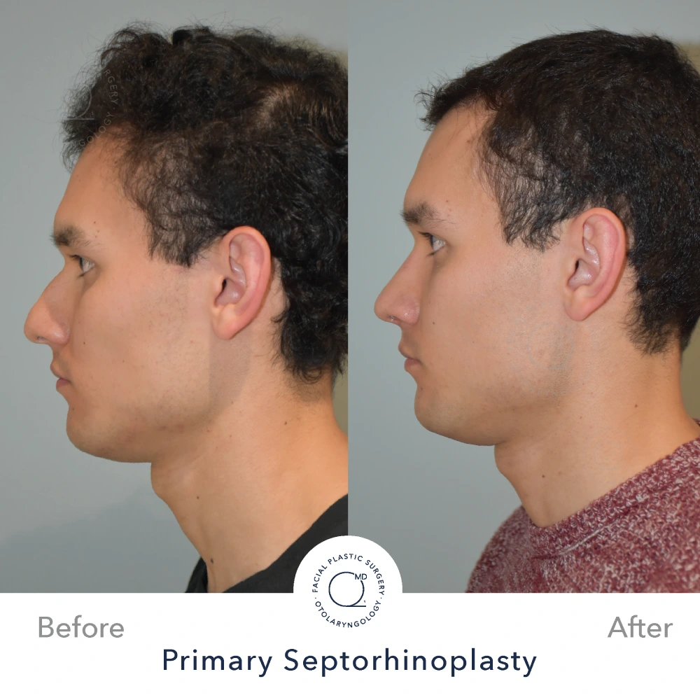 Rinoplastia Madrid caso 18 fotografía 1