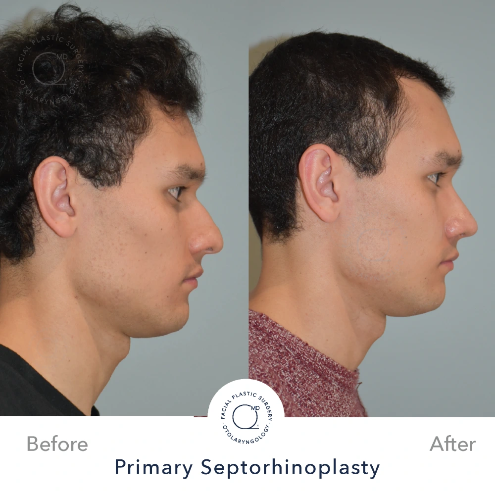 Rinoplastia Madrid caso 18 fotografía 2