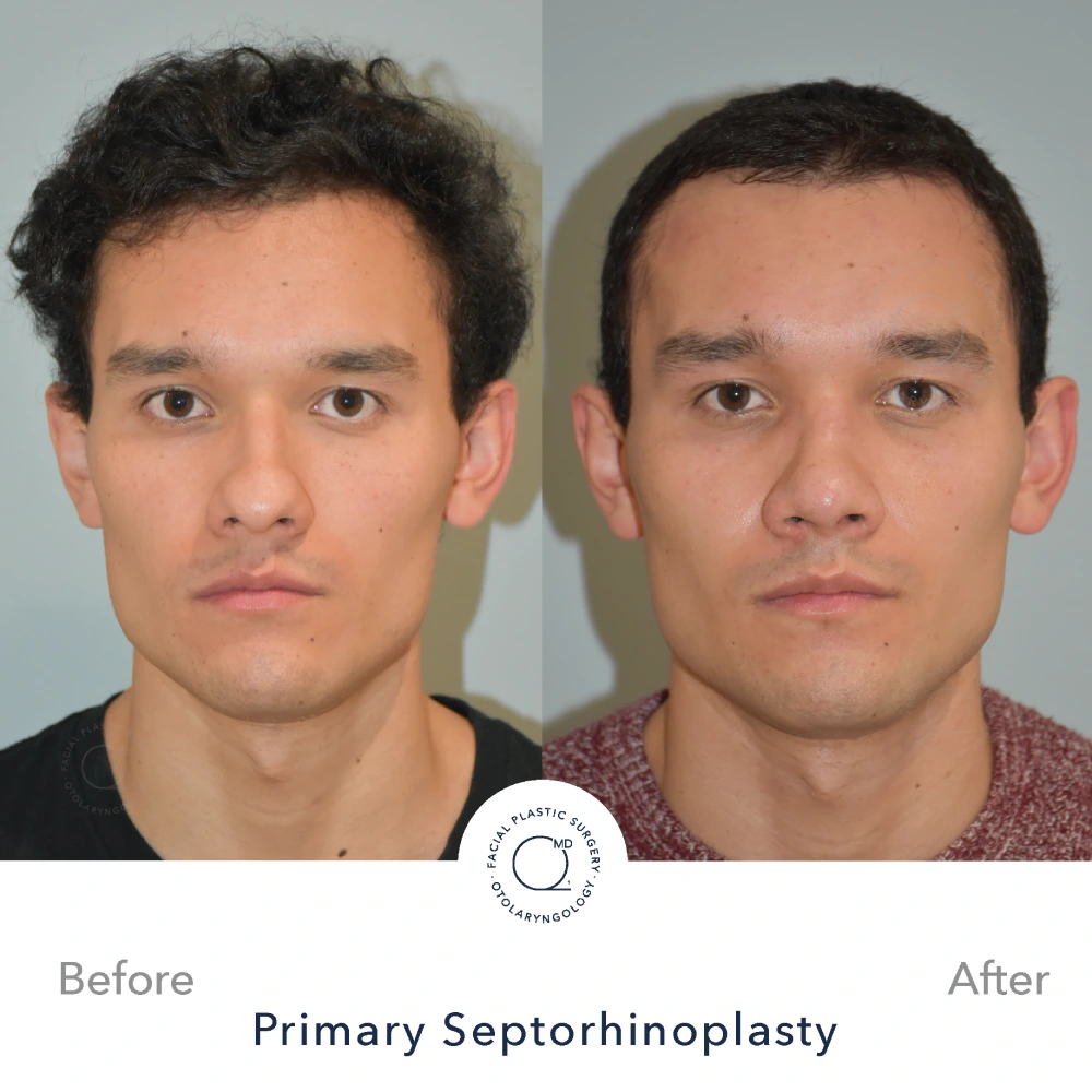 Rinoplastia Madrid caso 18 fotografía 3