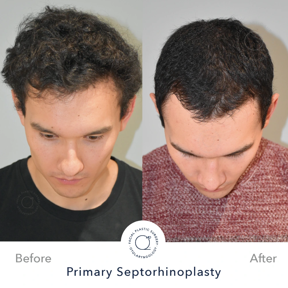 Rinoplastia Madrid caso 18 fotografía 4