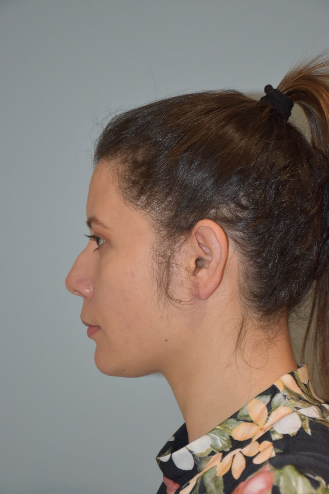Rinoplastia Madrid caso 19 fotografía 1