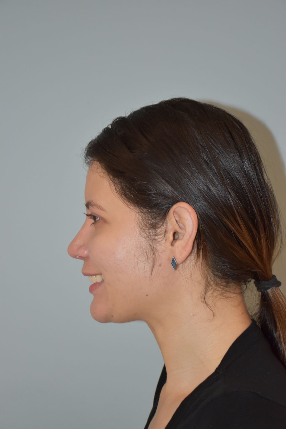 Rinoplastia Madrid caso 19 fotografía 2
