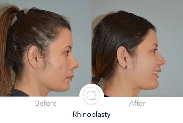 Rinoplastia Madrid caso 19 fotografía 3