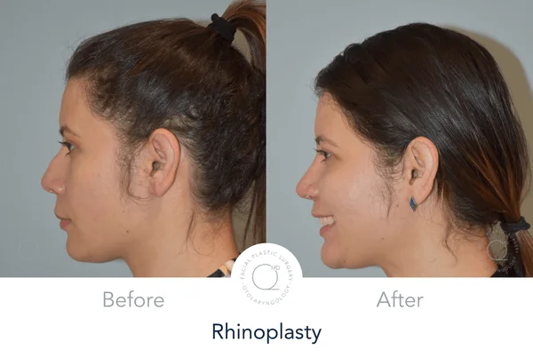 Rinoplastia Madrid caso 19 fotografía 4