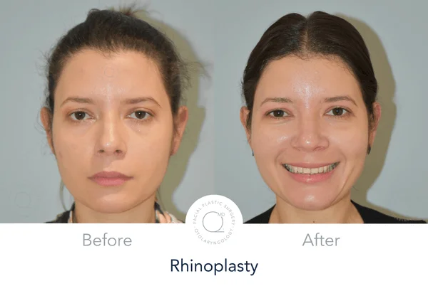 Rinoplastia Madrid caso 19 fotografía 5