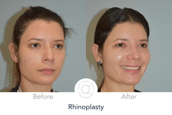 Rinoplastia Madrid caso 19 fotografía 6
