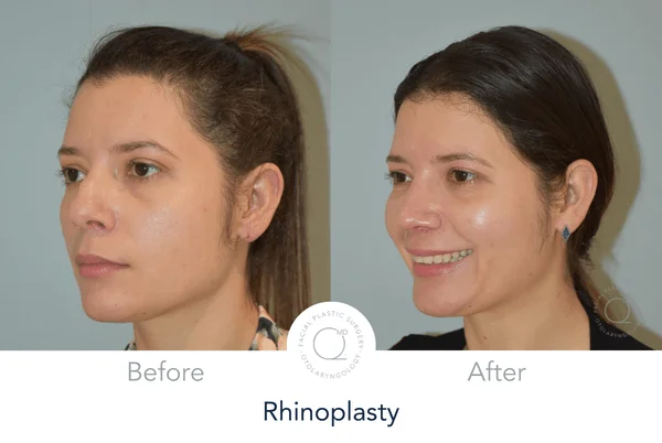 Rinoplastia Madrid caso 19 fotografía 7