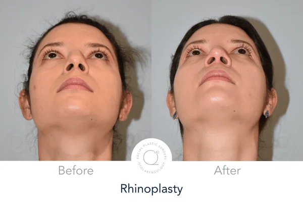Rinoplastia Madrid caso 19 fotografía 8