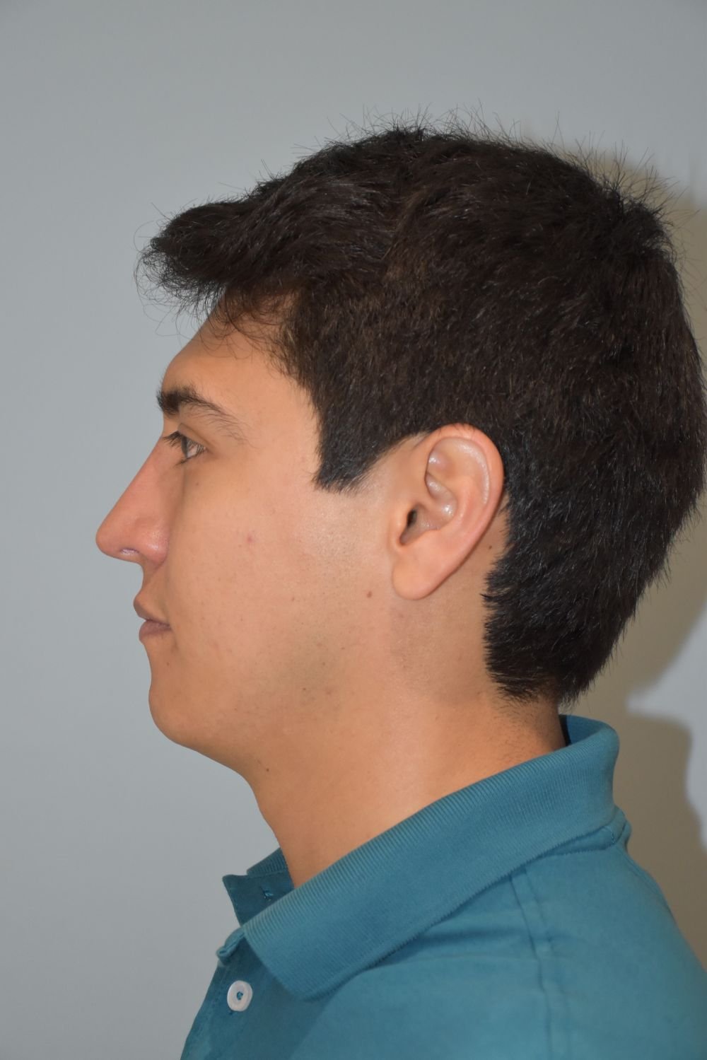 Rinoplastia Madrid caso 22 fotografía 2