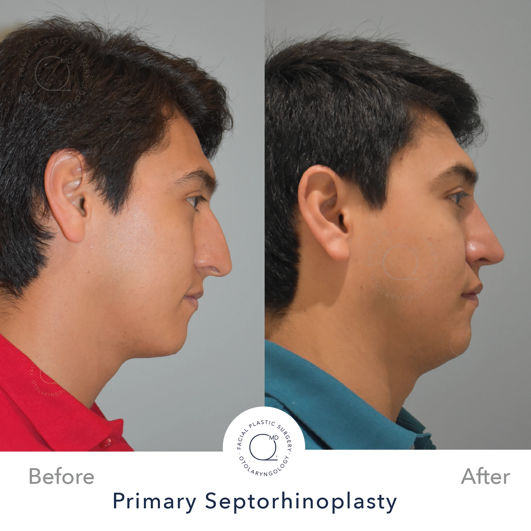 Rinoplastia Madrid caso 22 fotografía 3