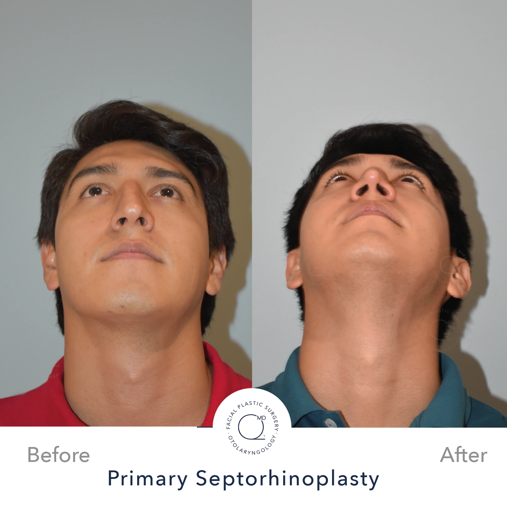 Rinoplastia Madrid caso 22 fotografía 4