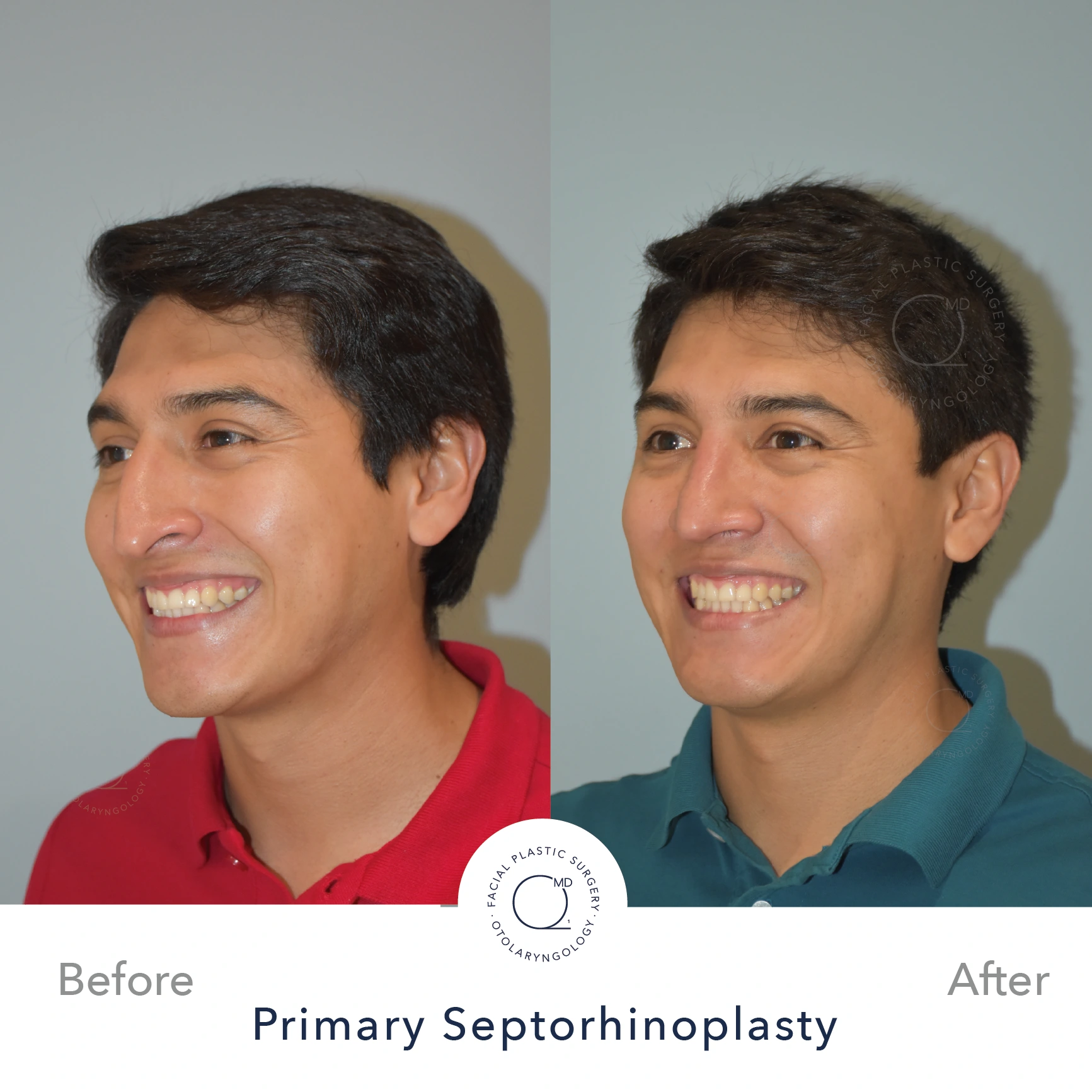 Rinoplastia Madrid caso 22 fotografía 5