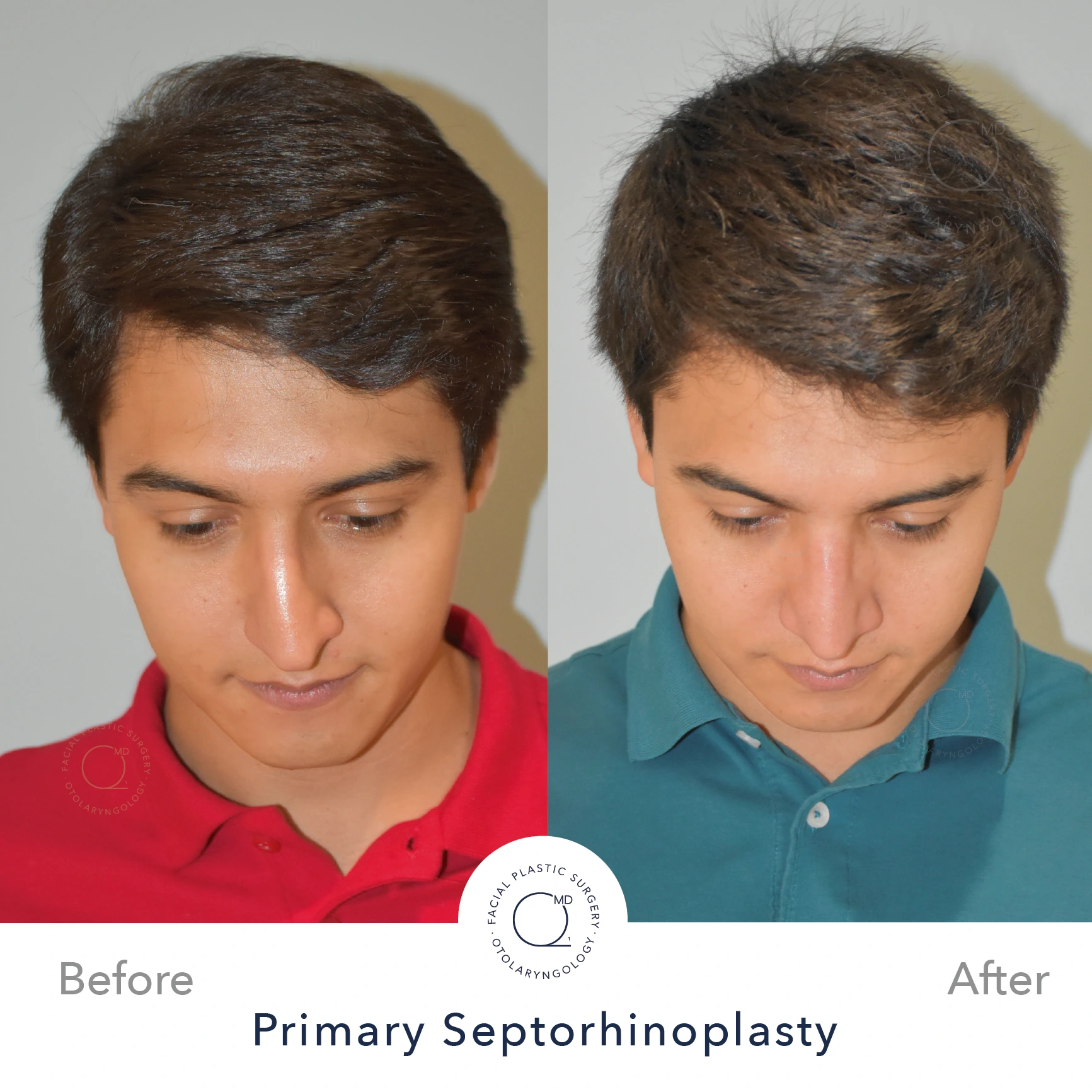 Rinoplastia Madrid caso 22 fotografía 6