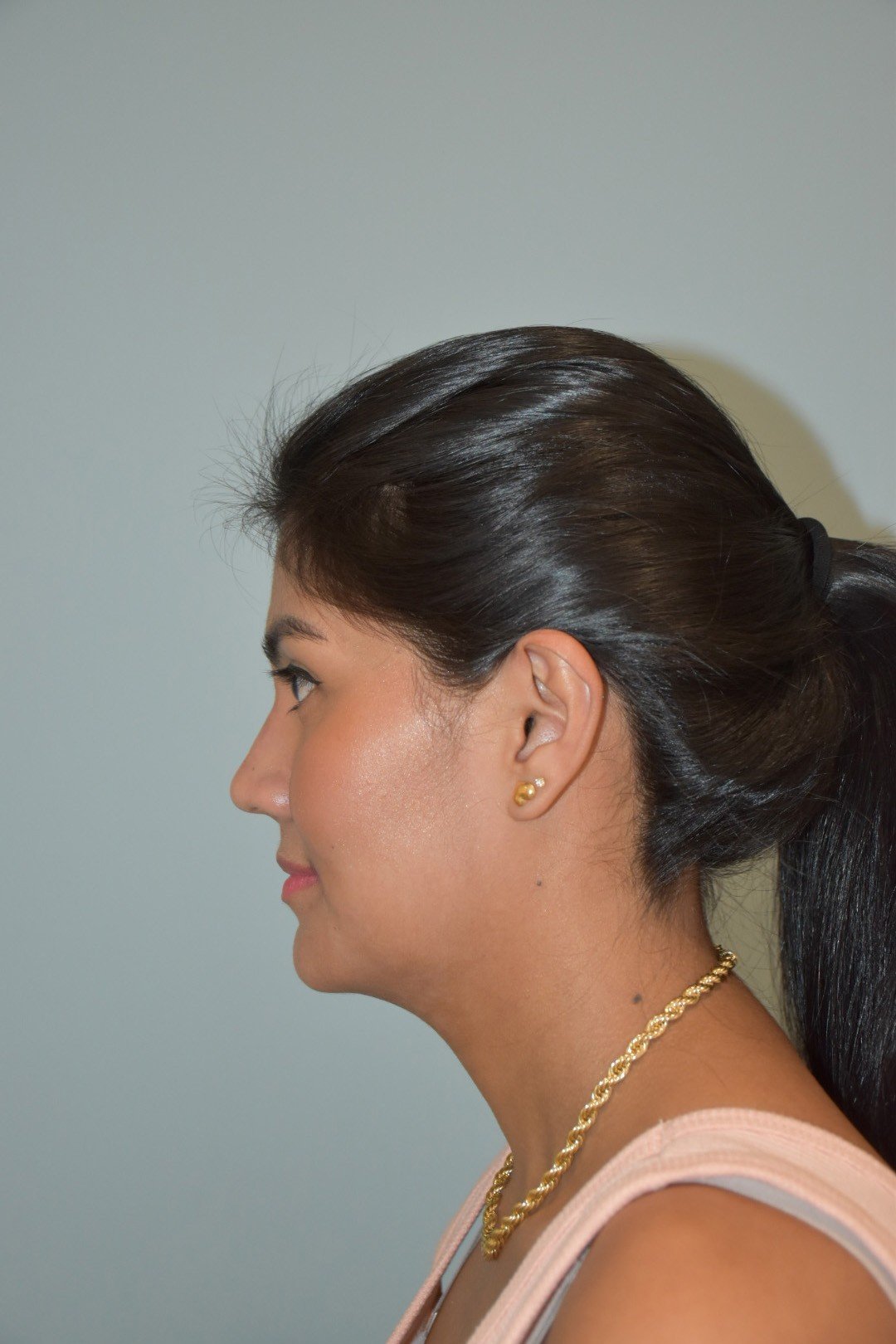 Rinoplastia Madrid caso 23 fotografía 2