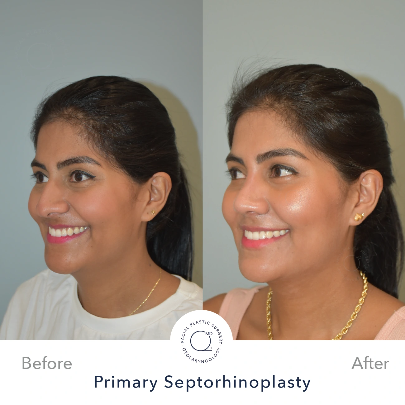 Rinoplastia Madrid caso 23 fotografía 3